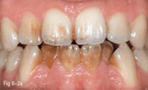 how is chewing tobacco bad Chewing tobacco linked to higher stroke and cancer risk, study finds how is chewing tobacco bad Chewing tobacco linked to higher stroke and cancer risk, study finds